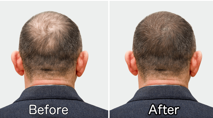 hair lossing improved image02
